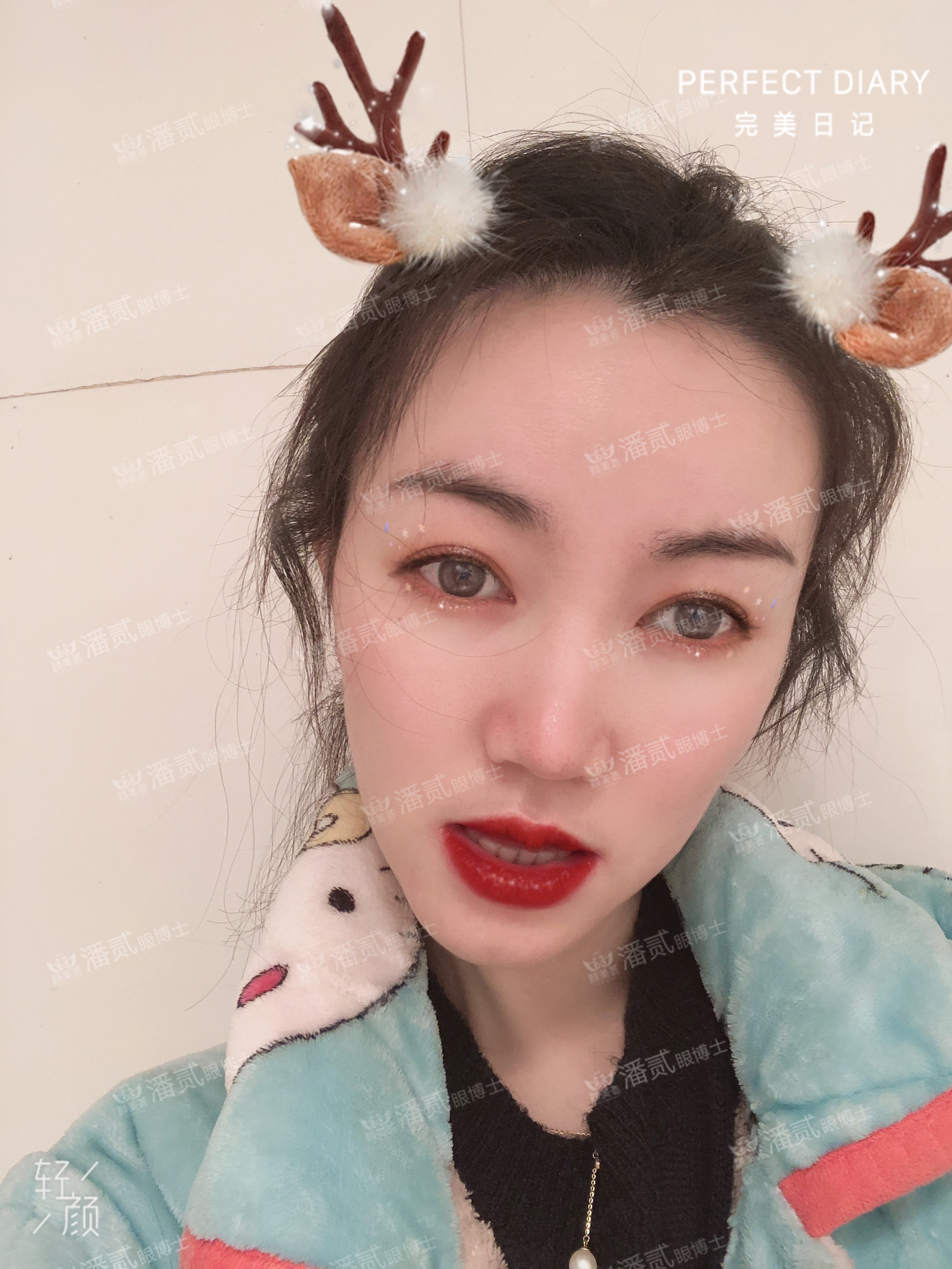 广州双眼皮修复内双,广州双眼皮修复可以只修眼尾吗