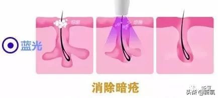 菜市场照猪肉的灯能美白吗,菜市场照肉的灯