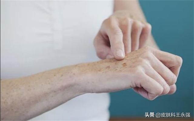 长了老年斑，有办法淡化吗？是否能彻底去除，皮肤科医生给你答案