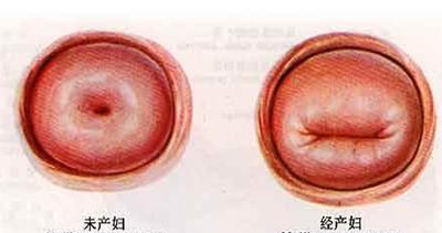 绝经五年又出血有必要切除子宫吗,绝经5年了取环有危险吗
