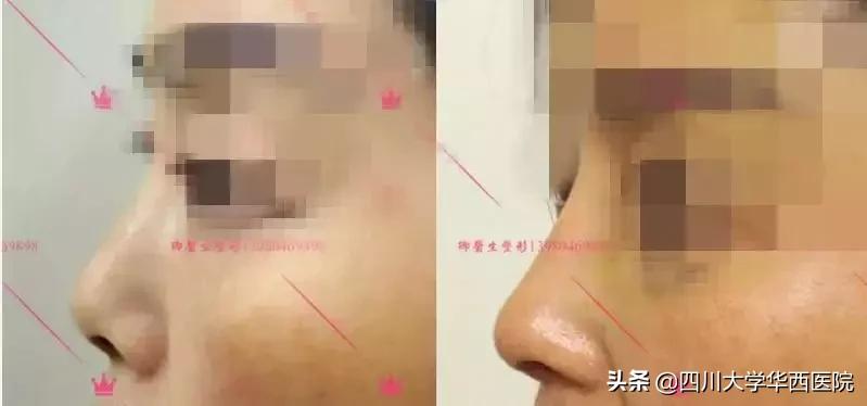 鼻子太翘怎么整形,鼻子太尖整形修复最佳方法