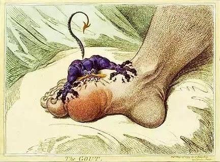 痛风急性发作如何快速缓解疼痛,痛风急性发作时疼得受不了怎么办