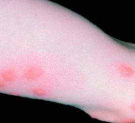 快速灭臭虫方法,家里有臭虫怎么灭才干净