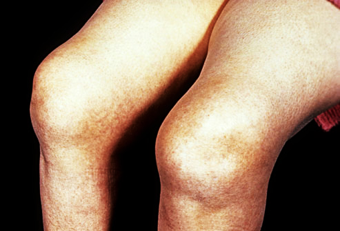 膝盖积水以后是热敷还是冷敷？真能解决问题吗？医生：可能都没用