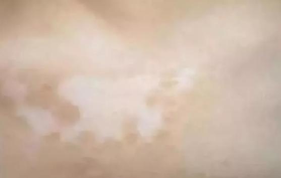 头皮白癜风症状好转图片,白癜风好转的几个迹象图片