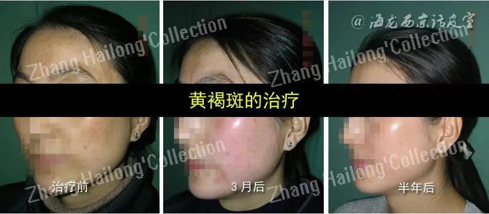 褐青斑怎么治疗最有效果,褐青斑有哪些治疗方法