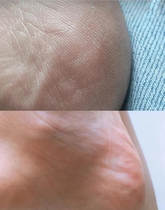 脚后跟干裂脱皮教你一招实用省钱,脚后跟总是干裂起皮的人注意