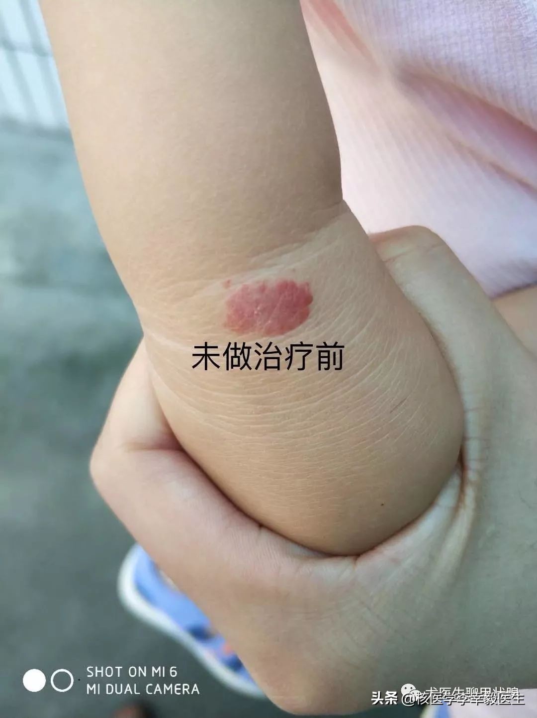 瘢痕疙瘩毛细血管扩张,毛细血管瘤治疗后留疤怎么去除