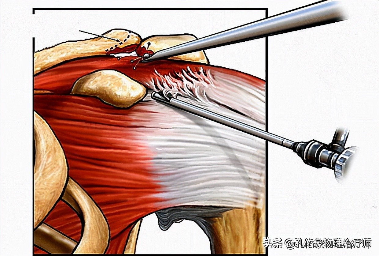 肩膀痛不知什么原因,教你一个动作解决肩膀疼痛