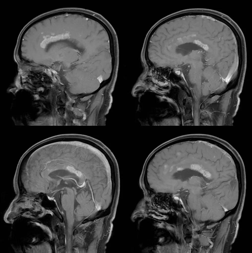 胼胝体有什么症状,胼胝体形态较小可以治疗吗