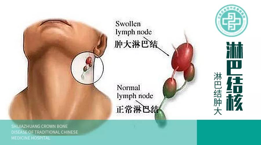 淋巴结核和淋巴瘤的超声鉴别,淋巴结核病理分析