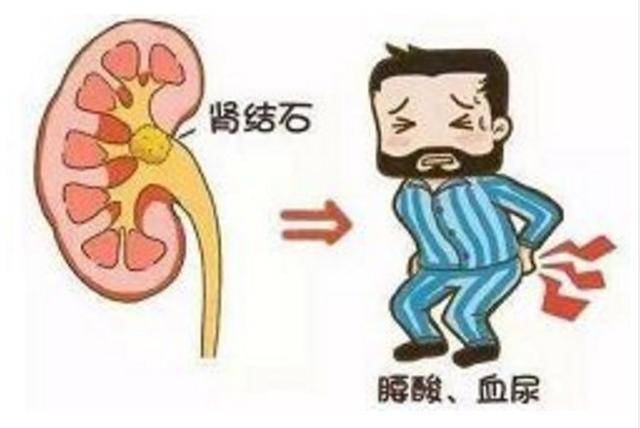 导致腰痛的肾结石严重吗,腰酸背痛是肾结石吗