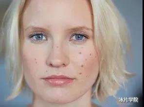 痤疮皮肤毛囊发炎应该怎么办,痤疮毛孔粗大皮肤粗糙