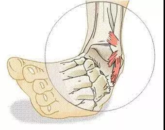 脚扭伤怎么治疗最佳方法,脚扭伤的正确处理方法