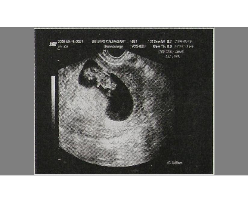 怀孕后胎芽多久能看到,怀孕一般几周可以看到孕囊