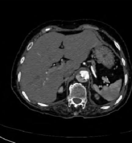 胸部Ct平扫能查出主动脉夹层吗,主动脉夹层cta影像图片解读