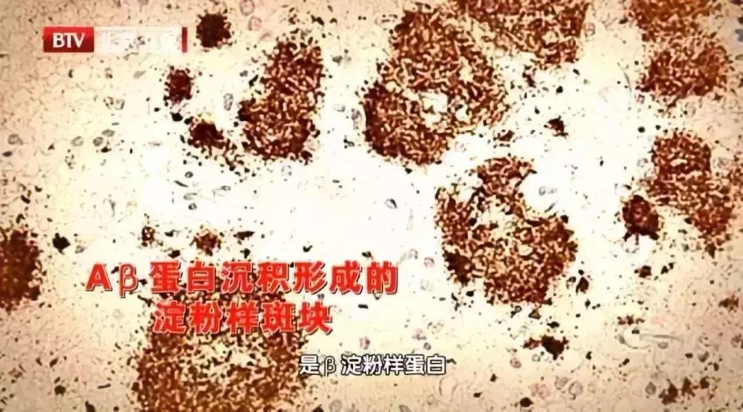 老年人老忘记事情是什么病的前兆,老忘事是什么病用什么药