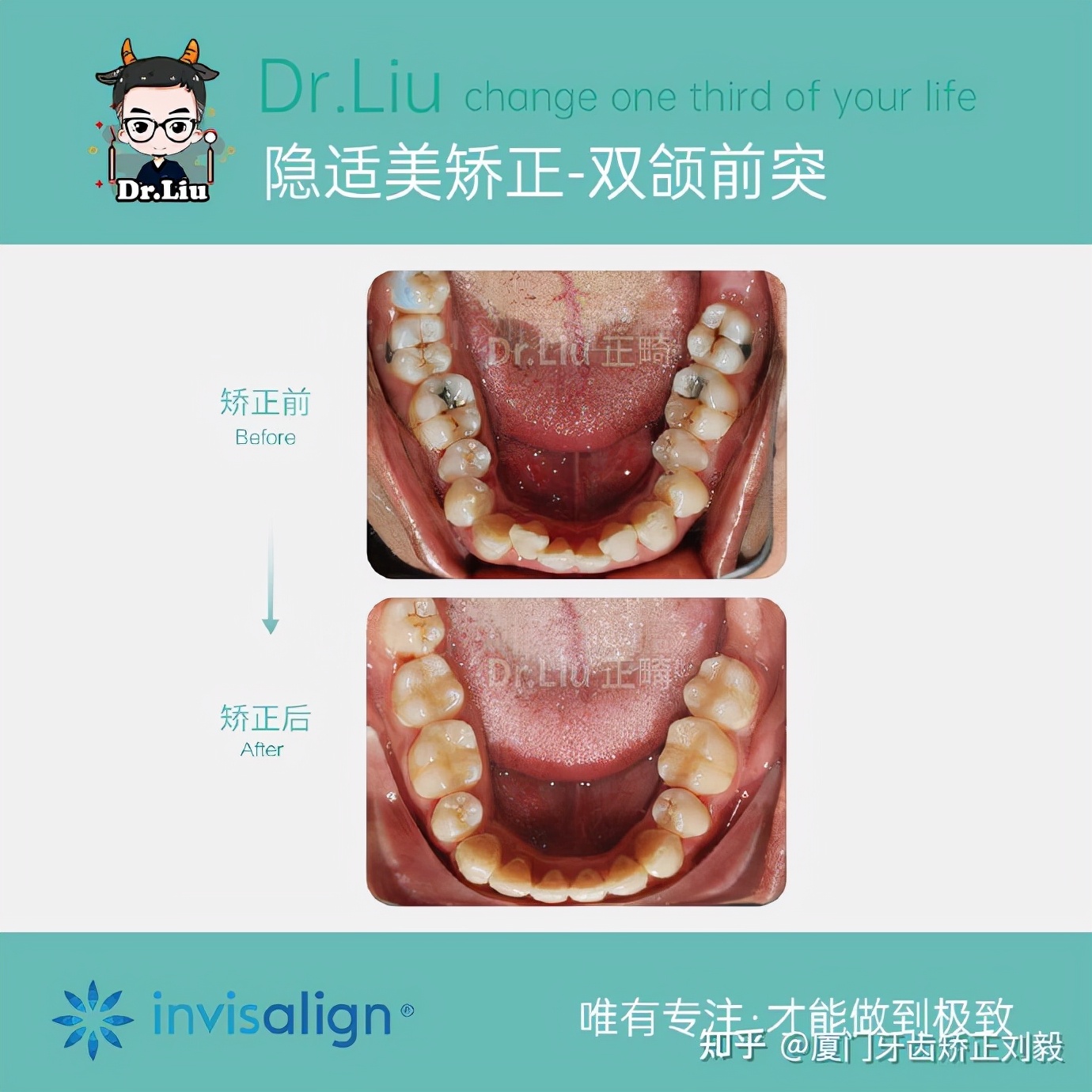 下嘴唇厚且外翻牙齿矫正,深覆合牙齿矫正嘴凸
