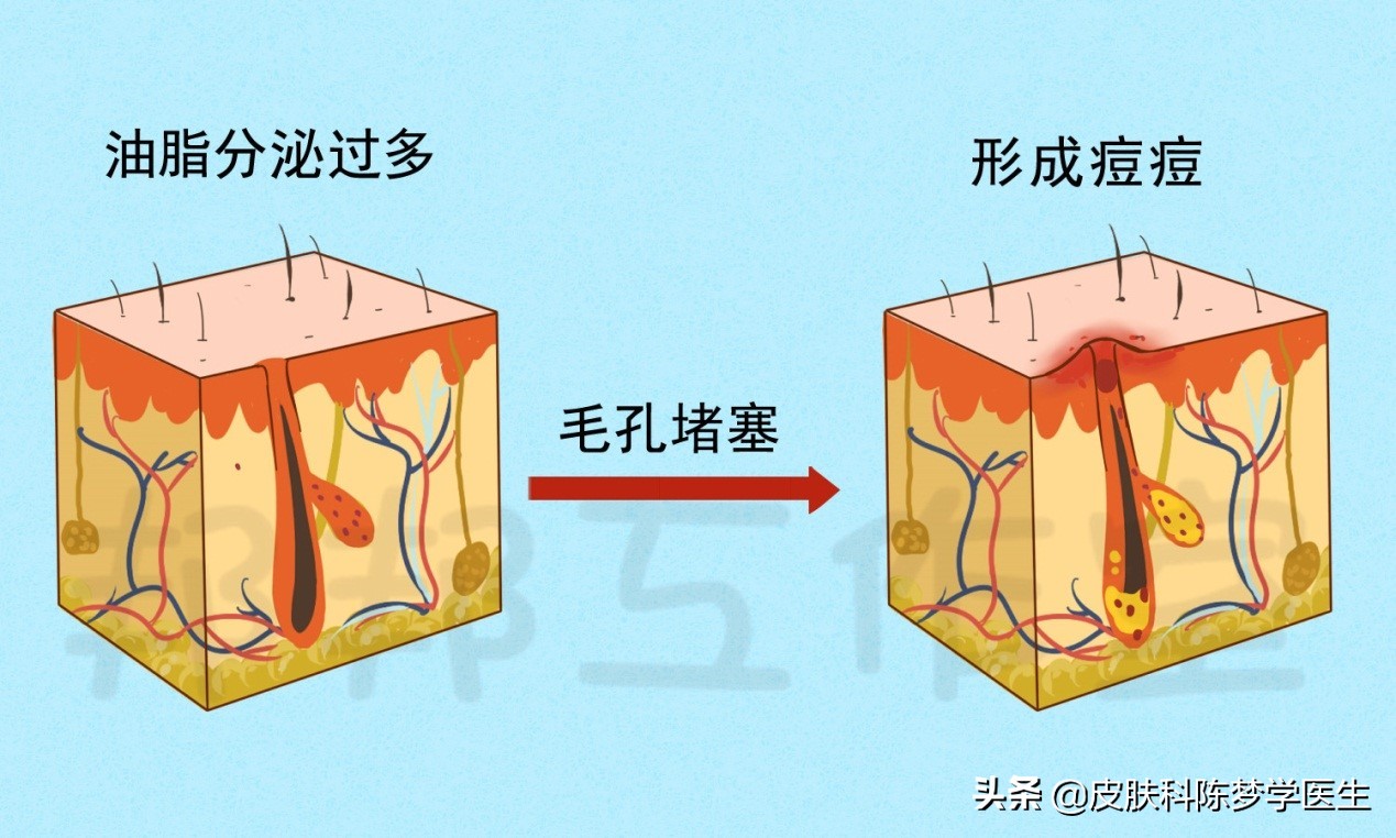 脸上爆发了严重的青春痘，这4种药物是首选