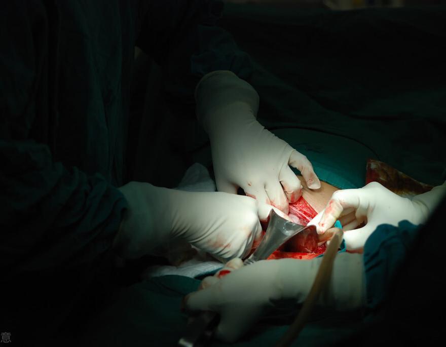 剖腹产后遗症都有什么,剖腹产顺带结扎有后遗症吗