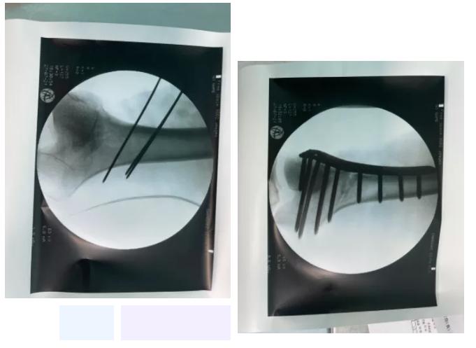 骨盆倾斜导致长短腿严重会怎样,长短腿骨盆倾斜