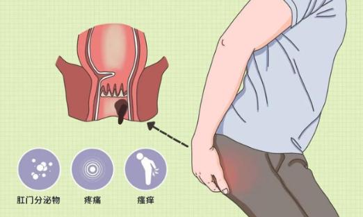 屁股上长火疖子和肛瘘的区别,屁股长脓疮是热毒还是什么