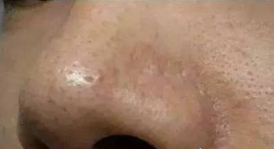 背后长粉刺痘痘是怎么回事,青春期孩子背后长痘是什么原因