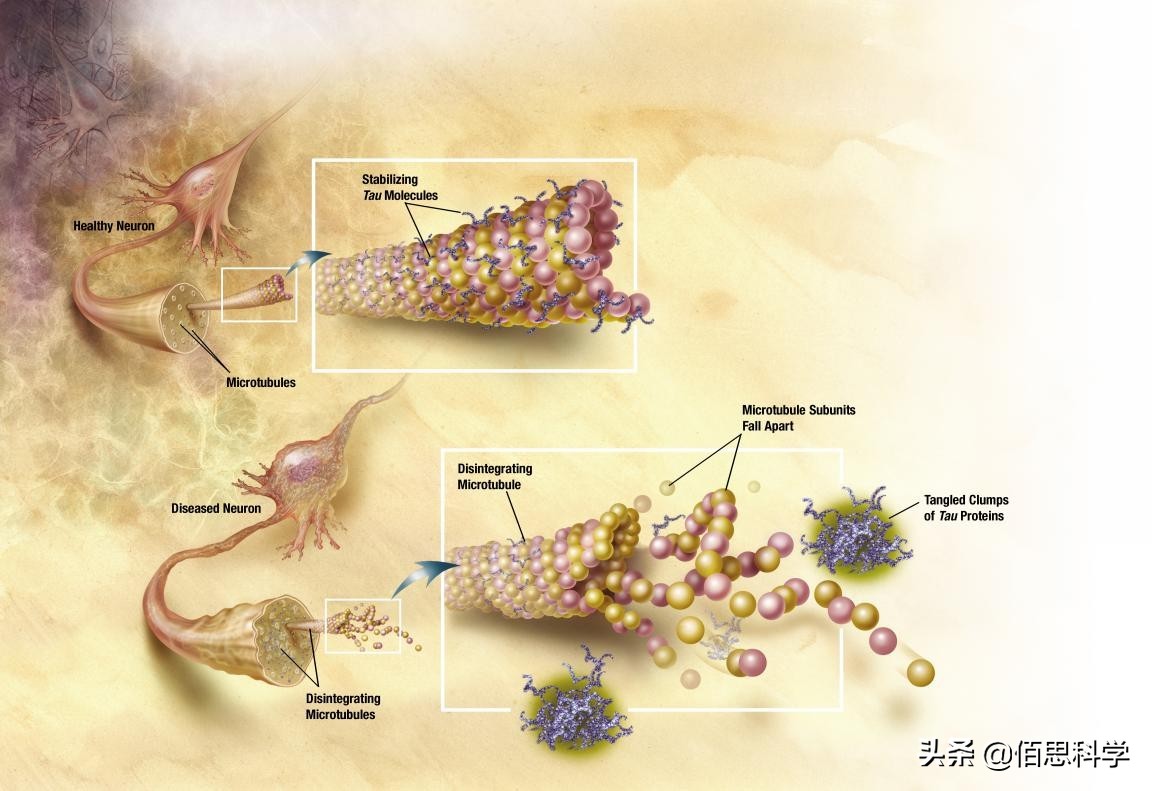 阿兹海默症跟失智症一样吗,阿兹海默病是帕金森吗