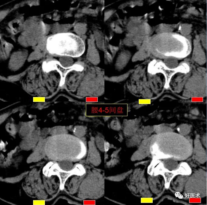 腰部ct需要注意事项,做腰部ct需要注意的事项