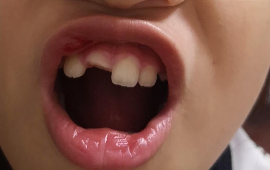 孩子摔一跤,小孩门牙摔断最好的方法怎么处理