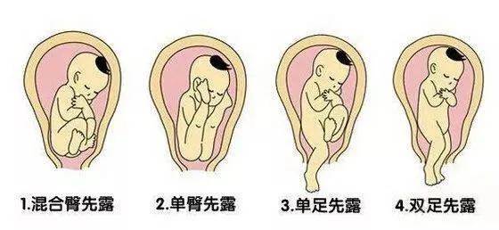 头先露胎盘1级会早产吗,胎位臀先露位什么意思