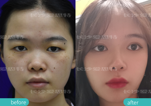 晒斑雀斑怎么区分,晒斑和雀斑有何不同夏季如何祛斑