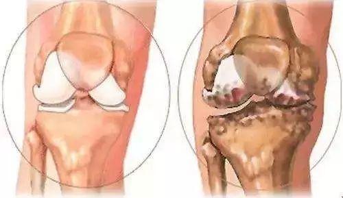 骨刺痛不痛,骨刺常识