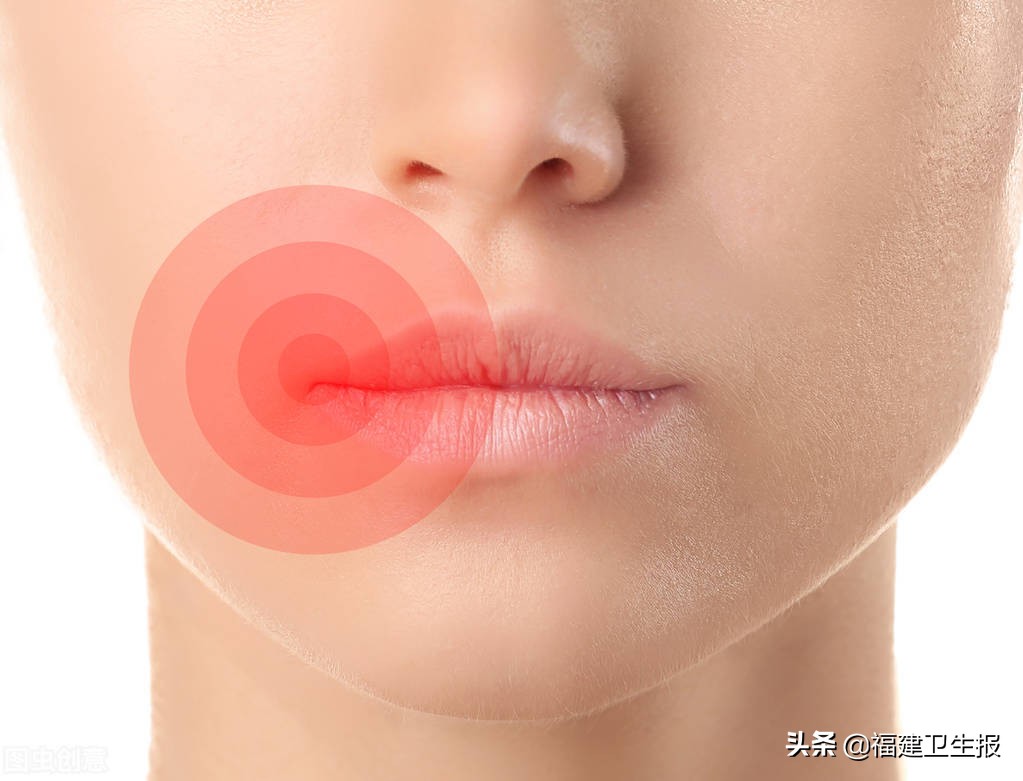 总是烂嘴角应该补充维生素b还是e,烂嘴角是上火还是缺维生素