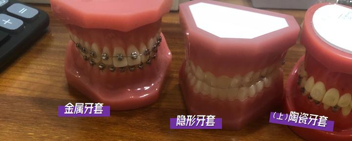 24岁戴牙套还能改善嘴凸吗,24岁戴牙套要戴多久保持器