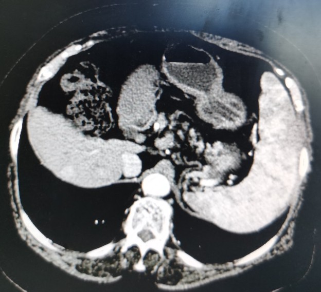 黄婶的肝癌用介入治疗已经3年多了-适合自己的治疗才是最好的治疗