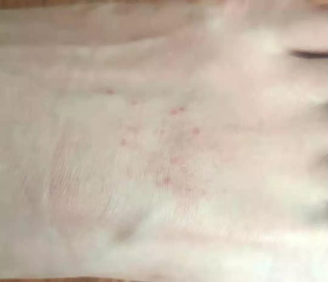 一坨痒痒的小疙瘩,咯吱窝一片一片的红疙瘩很痒