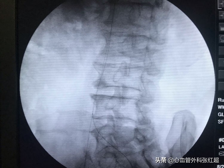 外周血管治疗图,外周血管疾病怎么治