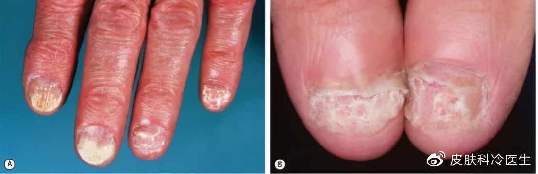 灰指甲就是灰色的吗,灰指甲的颜色是灰的吗