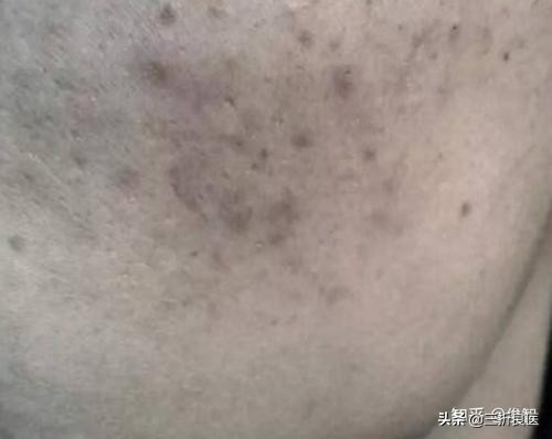 脸上黑色痘印痘疤怎么去除,壬二酸15%凝胶能去除老痘印痘疤吗