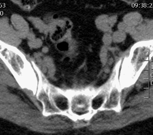 海绵状血管瘤在mri中的影像表现,骶骨处影像显示有血管瘤