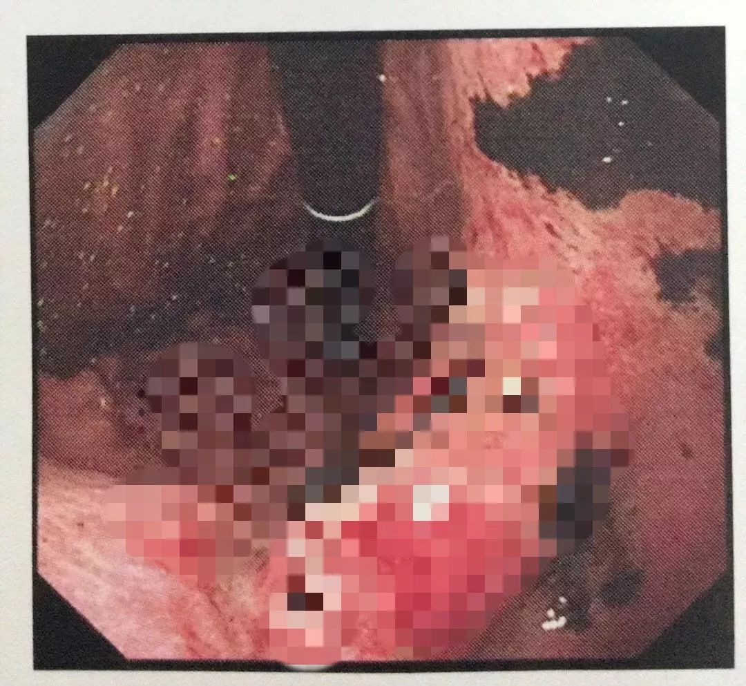 发现男友联系前任赌气吃辣条女子狂吃5包腹痛呕吐不止