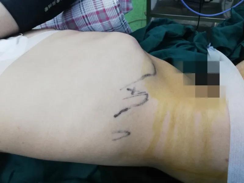 经皮肾镜切开取石术,超微可视经皮肾镜碎石取石术危险