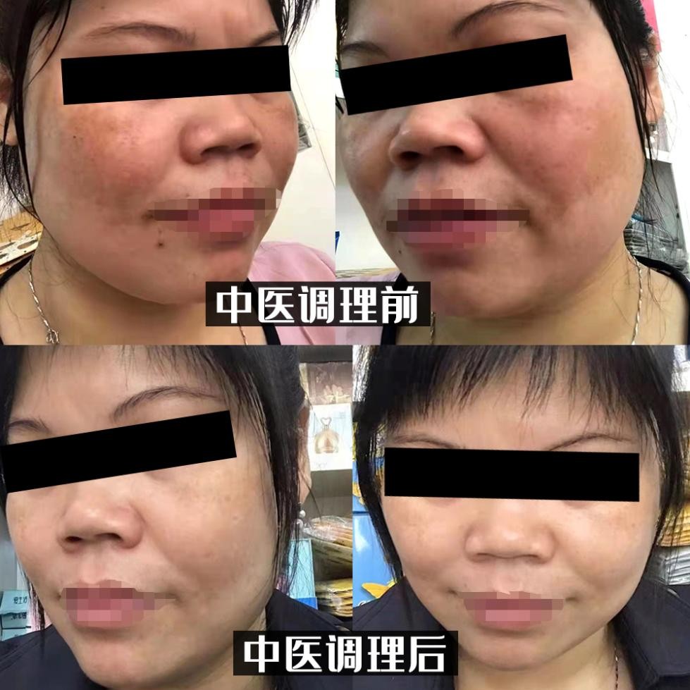 欧阳医生带你了解*褐斑黄**的成因及预防