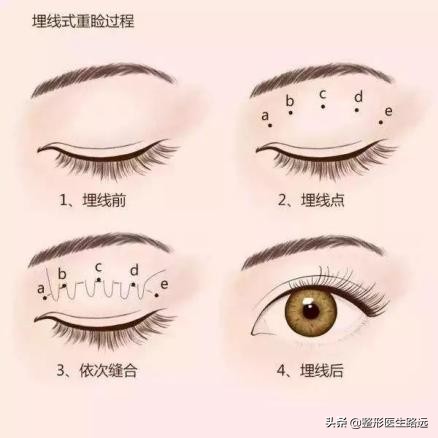 西安哪家双眼皮做的好,西安医美整形双眼皮