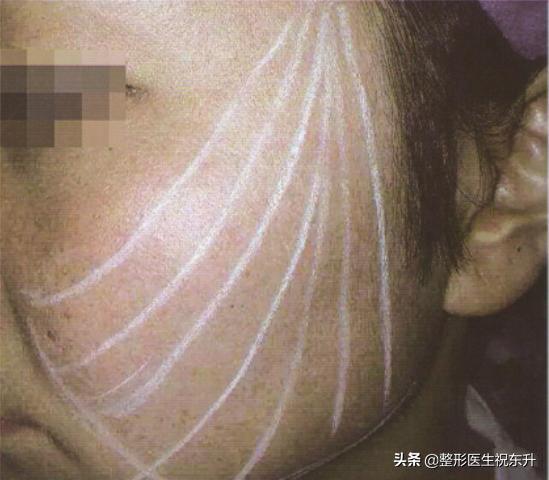 线雕提升脸会肿吗,线雕埋线有排异反应吗