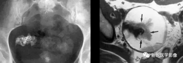 腹部平片可以看出肠胃疾病吗,腹部散在结节状高密度影