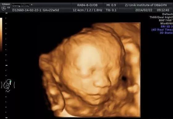 四维超声和二维b超的区别,产检b超比前两次小