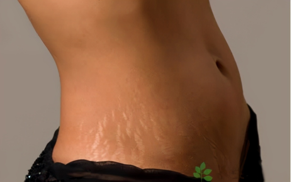 肥胖纹和妊娠纹消除方法,肥胖纹妊娠纹怎么消除