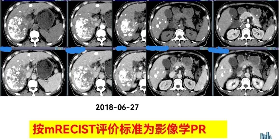 肝癌晚期靶向治疗怎么做,中国肝癌tace治疗展望